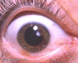 Cataract, Membranous